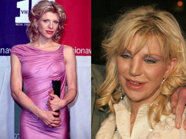 Celebrities-plastic-surgeries-8