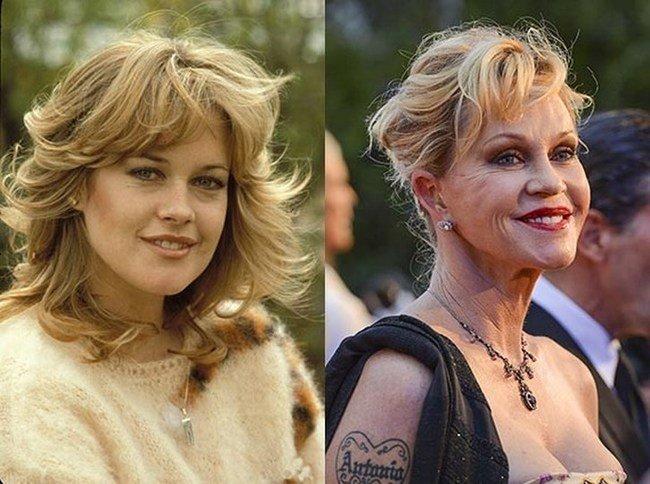 Celebrities-plastic-surgeries-7